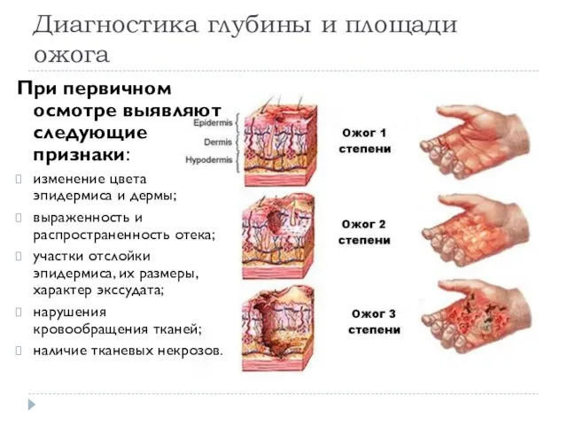 Диагностика глубины и площади ожога При первичном осмотре выявляют следующие