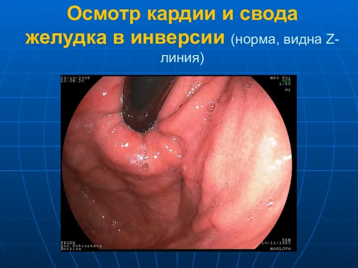 Осмотр кардии и свода желудка в инверсии (норма, видна Z-линия)