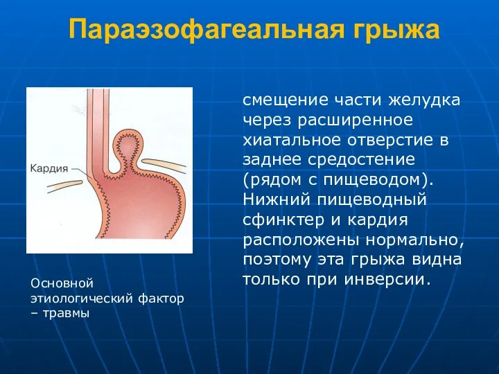 Параэзофагеальная грыжа смещение части желудка через расширенное хиатальное отверстие в