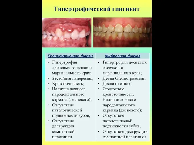 Гипертрофический гингивит