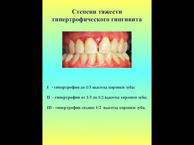 Степени тяжести гипертрофического гингивита I - гипертрофия до 1/3 высоты коронки зуба; II