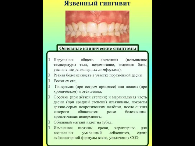 Язвенный гингивит Основные клинические симптомы Нарушение общего состояния (повышение температуры тела, недомогание, головная