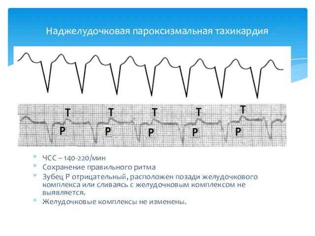 ЧСС – 140-220/мин Сохранение правильного ритма Зубец Р отрицательный, расположен