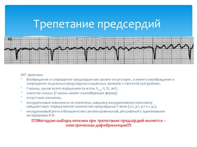 ЭКГ признаки Возбуждение и сокращение предсердия как целого отсутствует, а