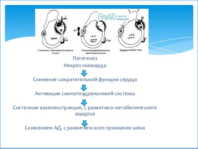 Патогенез Некроз миокарда Снижение сократительной функции сердца Активация симпатоадреналовой системы