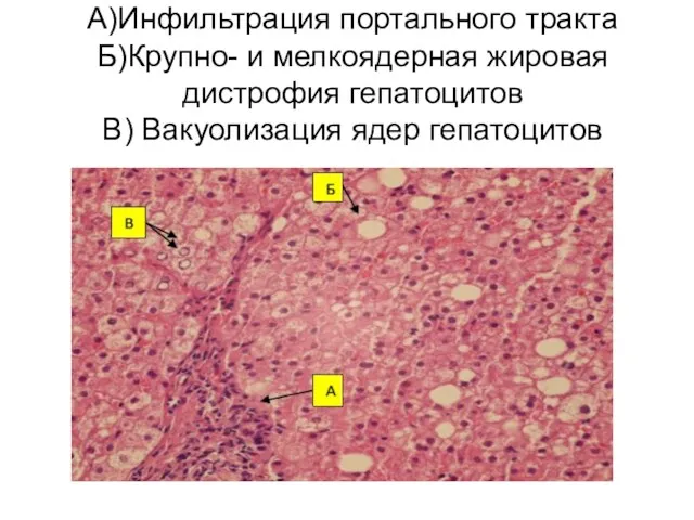 А)Инфильтрация портального тракта Б)Крупно- и мелкоядерная жировая дистрофия гепатоцитов В) Вакуолизация ядер гепатоцитов