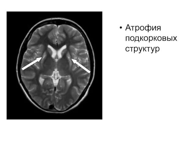 Атрофия подкорковых структур