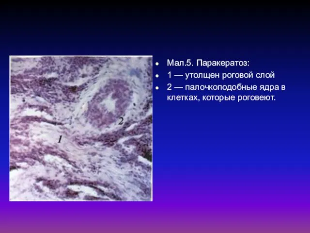 Мал.5. Паракератоз: 1 — утолщен роговой слой 2 — палочкоподобные ядра в клетках, которые роговеют.