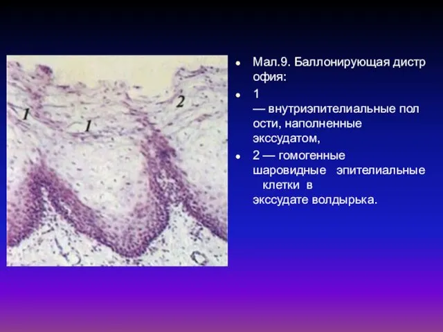Мал.9. Баллонирующая дистрофия: 1 — внутриэпителиальные полости, наполненные экссудатом, 2