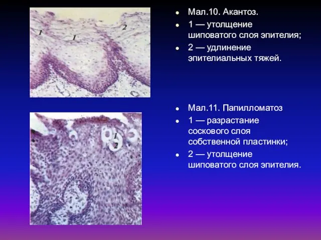 Мал.10. Акантоз. 1 — утолщение шиповатого слоя эпителия; 2 —