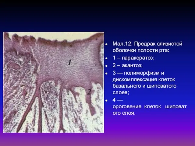 Мал.12. Предрак слизистой оболочки полости рта: 1 – паракератоз; 2