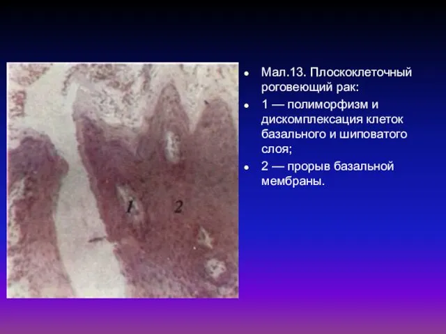Мал.13. Плоскоклеточный роговеющий рак: 1 — полиморфизм и дискомплексация клеток