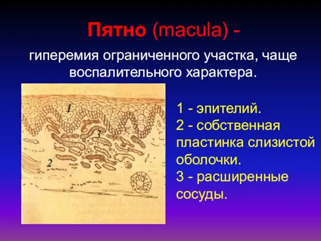 Пятно (macula) - гиперемия ограниченного участка, чаще воспалительного характера. 1