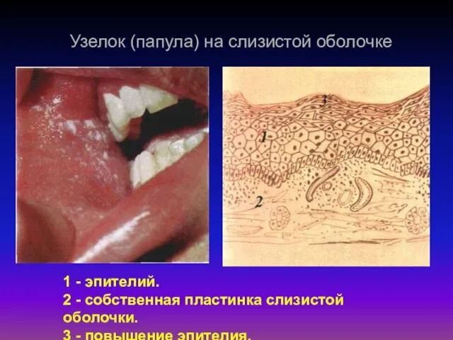 Узелок (папула) на слизистой оболочке 1 - эпителий. 2 -