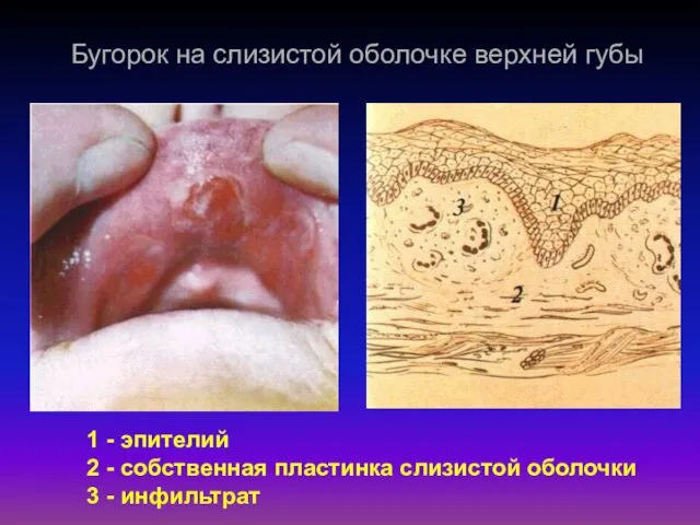 Бугорок на слизистой оболочке верхней губы 1 - эпителий 2