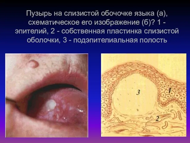 Пузырь на слизистой обочочке языка (а), схематическое его изображение (б)?