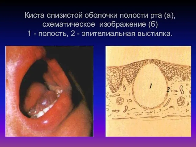 Киста слизистой оболочки полости рта (а), схематическое изображение (б) 1 - полость, 2 - эпителиальная выстилка.