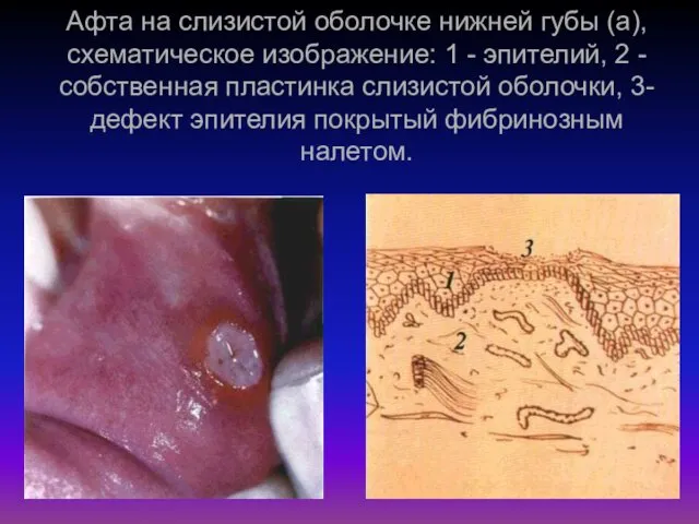 Афта на слизистой оболочке нижней губы (а), схематическое изображение: 1