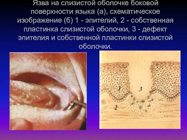 Язва на слизистой оболочке боковой поверхности языка (а), схематическое изображение