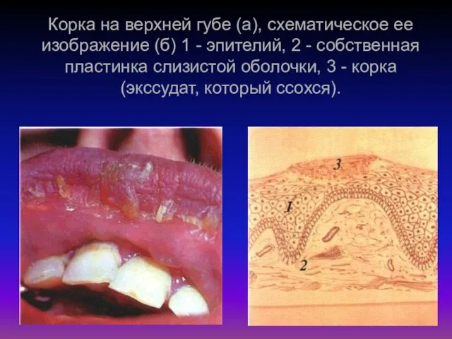 Корка на верхней губе (а), схематическое ее изображение (б) 1