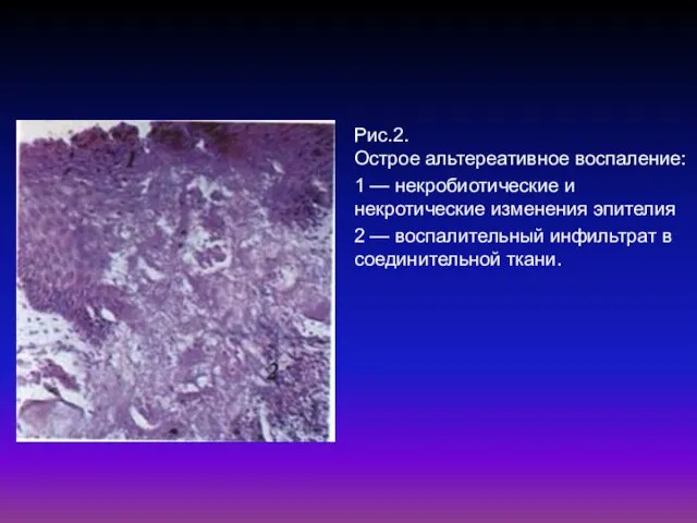 Рис.2. Острое альтереативное воспаление: 1 — некробиотические и некротические изменения