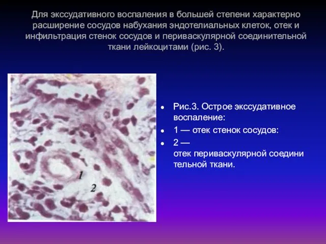 Для экссудативного воспаления в большей степени характерно расширение сосудов набухания