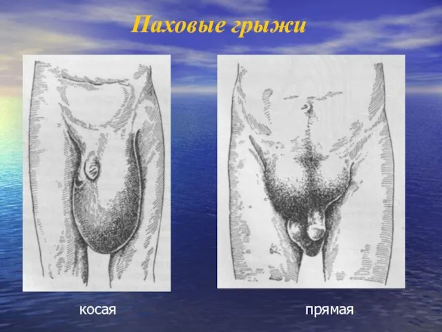 Паховые грыжи косая прямая