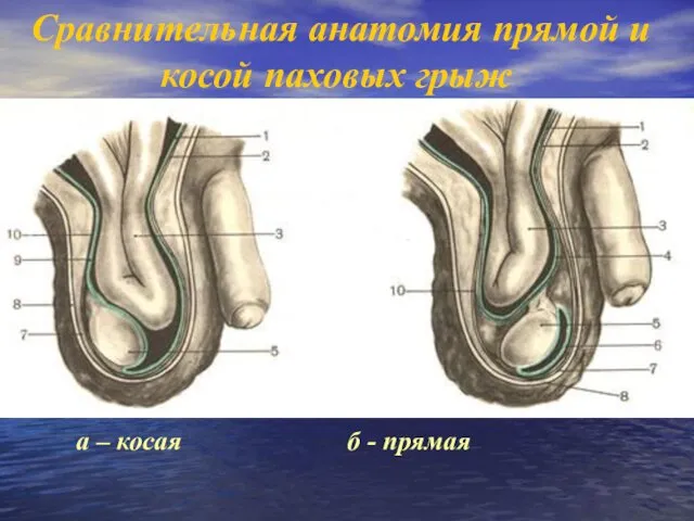 Сравнительная анатомия прямой и косой паховых грыж а – косая б - прямая