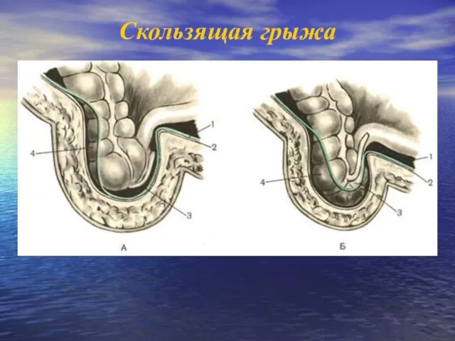 Скользящая грыжа