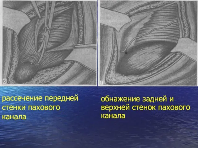 рассечение передней стенки пахового канала обнажение задней и верхней стенок пахового канала