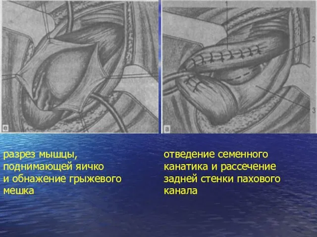 разрез мышцы, поднимающей яичко и обнажение грыжевого мешка отведение семенного