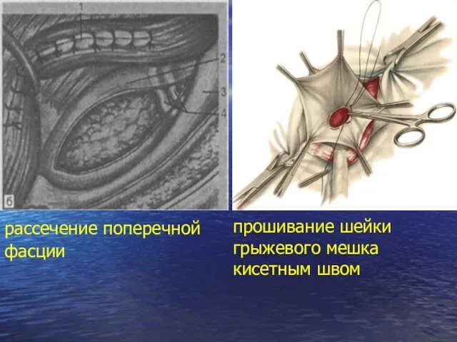 рассечение поперечной фасции прошивание шейки грыжевого мешка кисетным швом