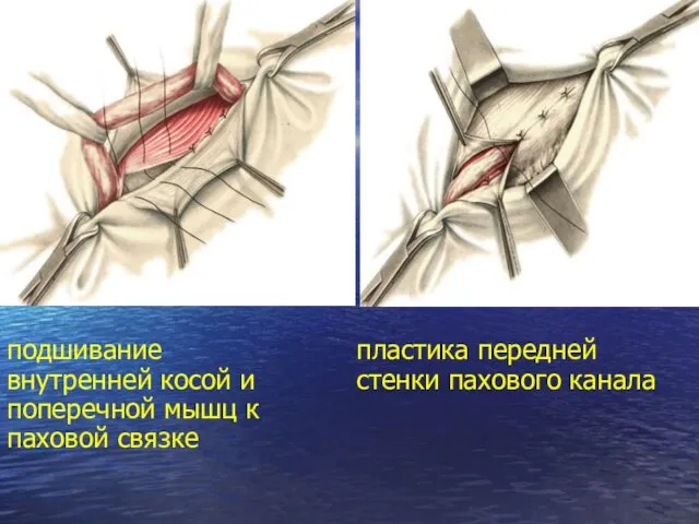 подшивание внутренней косой и поперечной мышц к паховой связке пластика передней стенки пахового канала