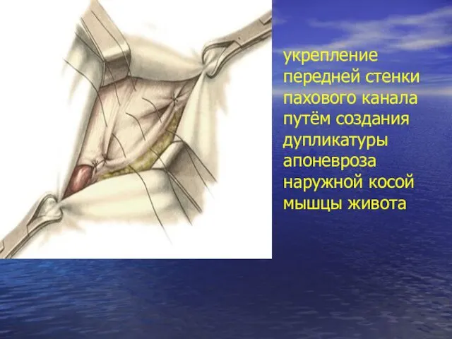 укрепление передней стенки пахового канала путём создания дупликатуры апоневроза наружной косой мышцы живота