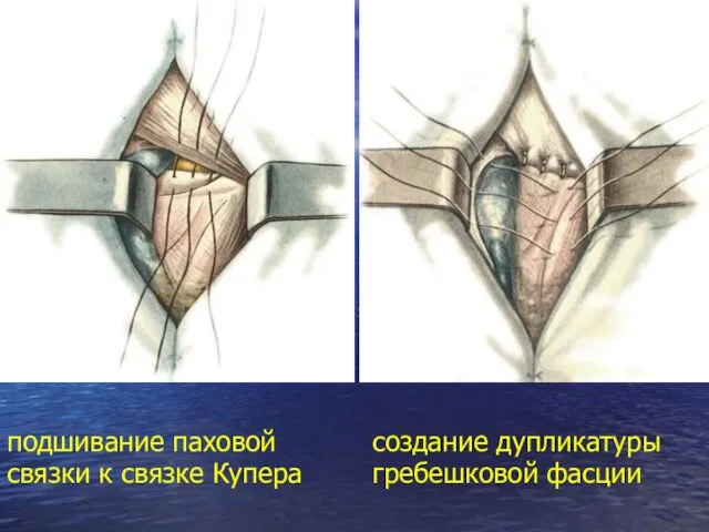 подшивание паховой связки к связке Купера создание дупликатуры гребешковой фасции