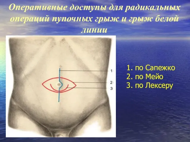 Оперативные доступы для радикальных операций пупочных грыж и грыж белой