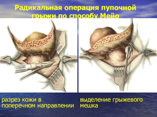 Радикальная операция пупочной грыжи по способу Мейо разрез кожи в поперечном направлении выделение грыжевого мешка