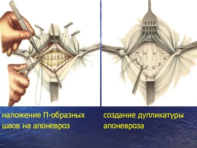 наложение П-образных швов на апоневроз создание дупликатуры апоневроза