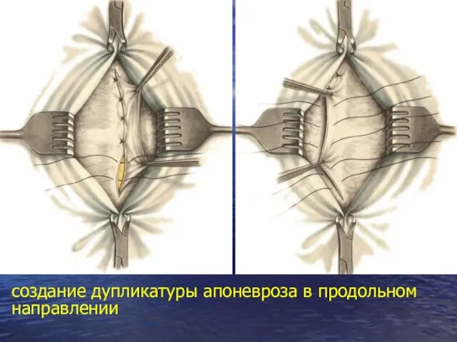 создание дупликатуры апоневроза в продольном направлении