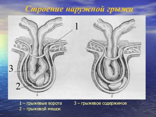 Строение наружной грыжи 1 – грыжевые ворота 3 – грыжевое содержимое 2 – грыжевой мешок