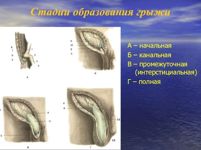 А – начальная Б – канальная В – промежуточная (интерстициальная) Г – полная Стадии образования грыжи