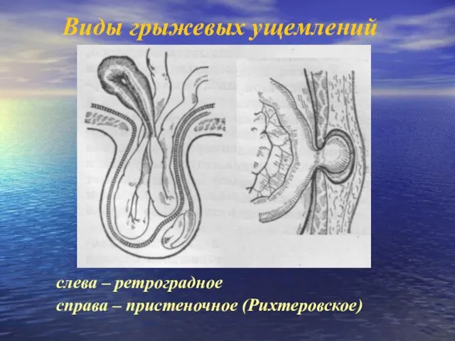 Виды грыжевых ущемлений слева – ретроградное справа – пристеночное (Рихтеровское)