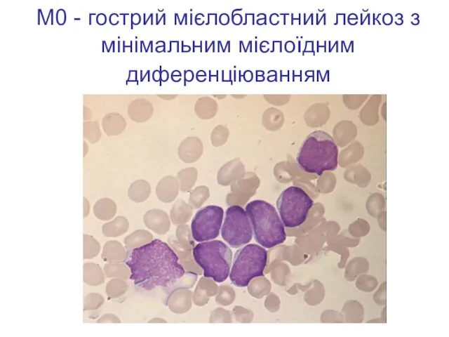 М0 - гострий мієлобластний лейкоз з мінімальним мієлоїдним диференціюванням