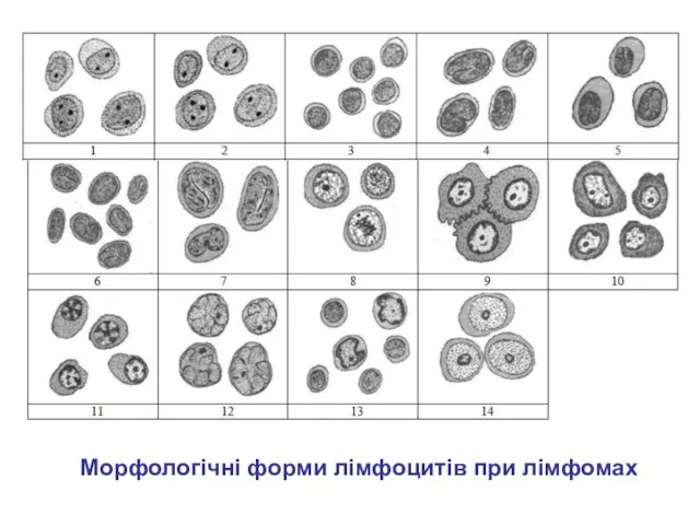 Морфологічні форми лімфоцитів при лімфомах