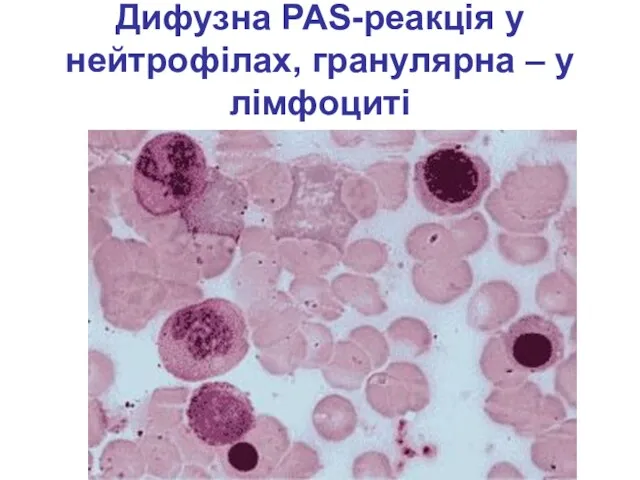 Дифузна PAS-реакція у нейтрофілах, гранулярна – у лімфоциті