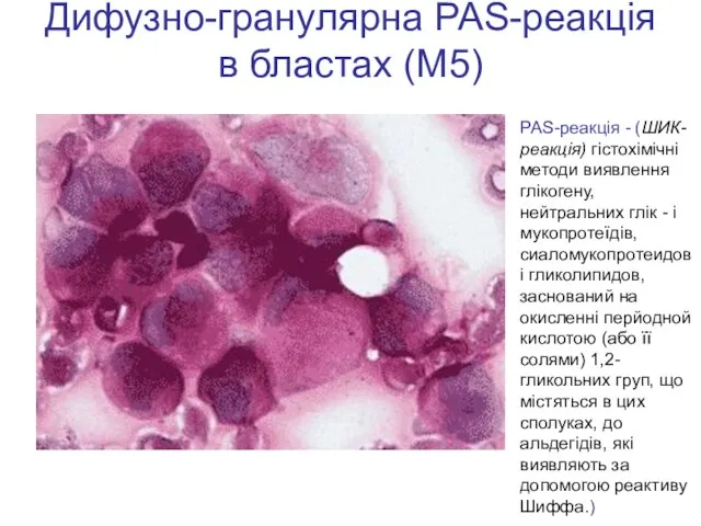 Дифузно-гранулярна PAS-реакція в бластах (М5) PAS-реакція - (ШИК-реакція) гістохімічні методи