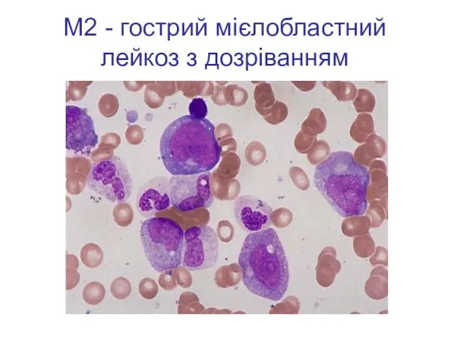 М2 - гострий мієлобластний лейкоз з дозріванням