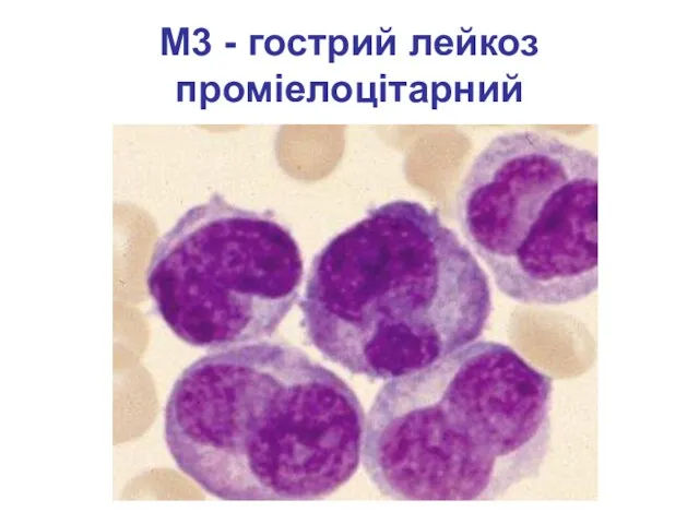 М3 - гострий лейкоз проміелоцітарний