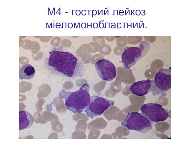 М4 - гострий лейкоз міеломонобластний.
