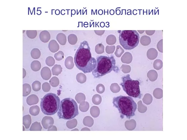 М5 - гострий монобластний лейкоз